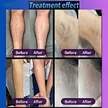facial laser hair removal
